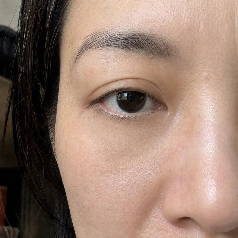 Under eyes after Plumessa