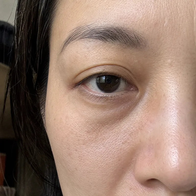 Under eyes before Plumessa