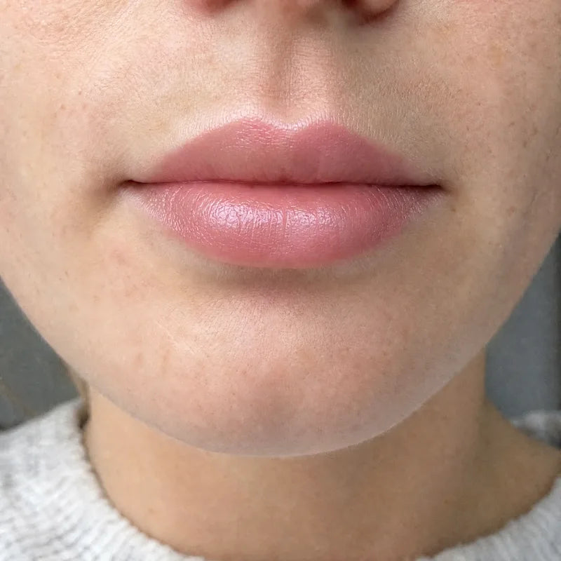 Lips after Plumessa