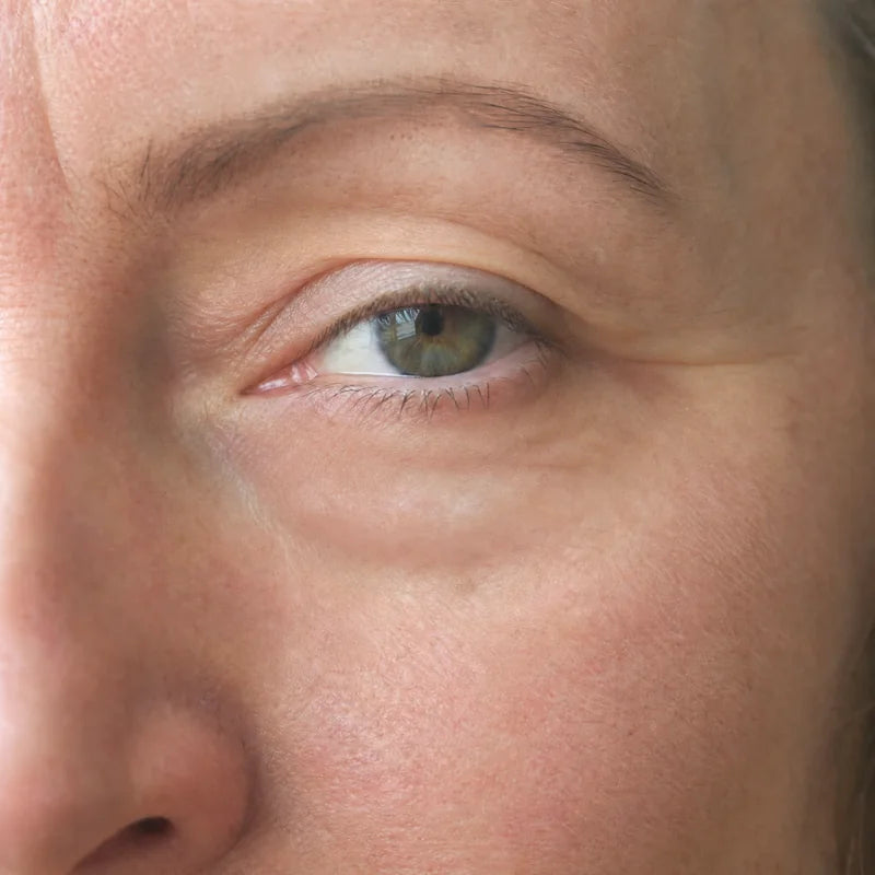 Under eyes after Plumessa