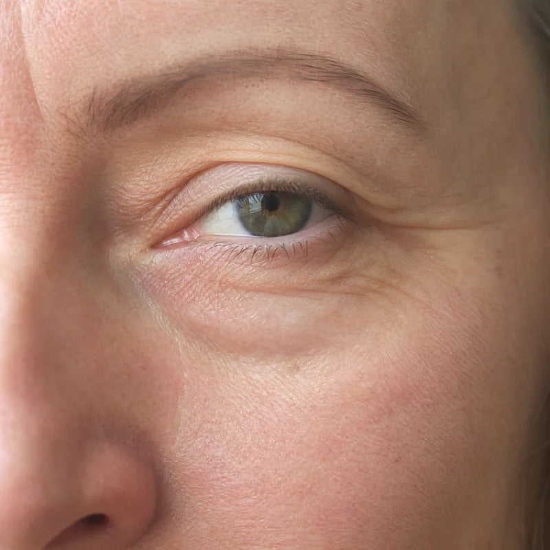 Under eyes before Plumessa