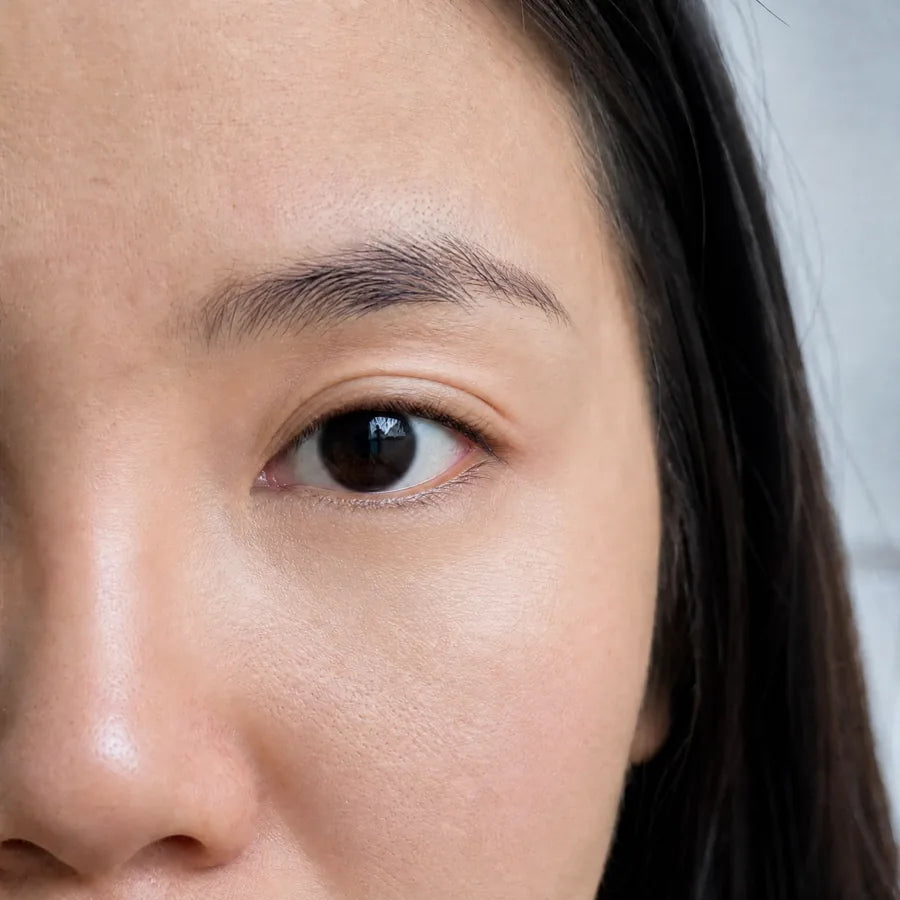 Dark circles after Plumessa