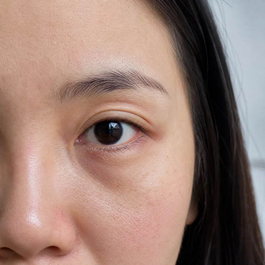 Dark circles before Plumessa