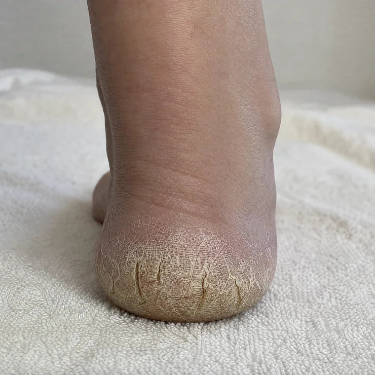 Cracked, dry heel before using Velvet 4 Pro