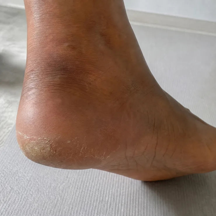 Before, heel pair 3