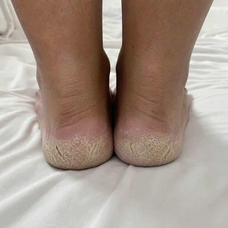 Before, heel pair 4
